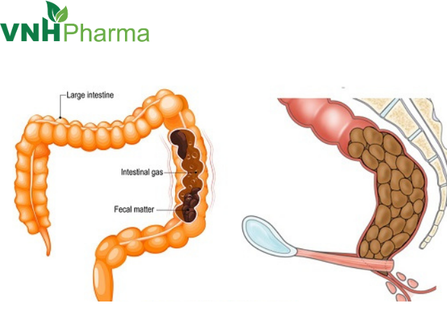 Phân biệt phân của trẻ táo bón để biết mức độ nặng nhẹ